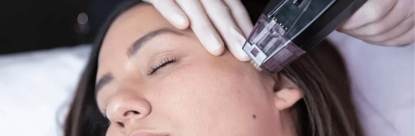 Image of a woman receiving a skin rejuvenation solution that combines microneedling with radiofrequency (RF) technology.